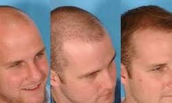 Hair Transplant Antalya – Haarex Clinic