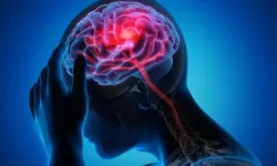 Beyinde sıvı birikmesi nedir? Tedavisi nasıl yapılır?