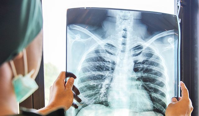 Zatürre Nedir, Neden Olur? Belirtileri, Türleri ve Tedavi Yöntemleri