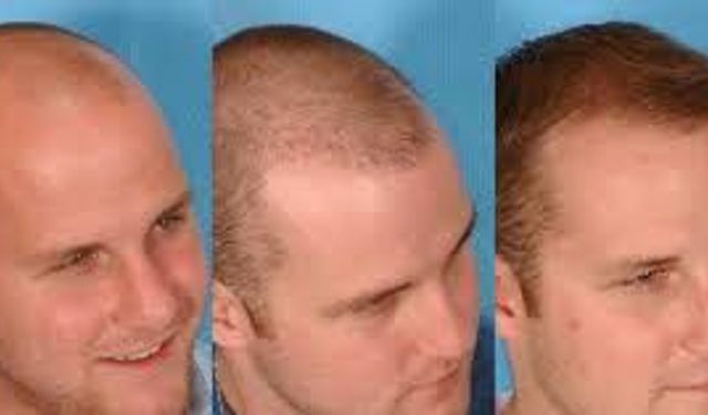 Hair Transplant Antalya – Haarex Clinic