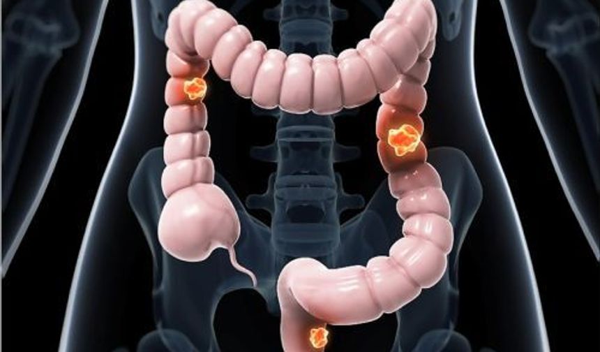 Kolon kanseri gençler arasında hızla yayılıyor