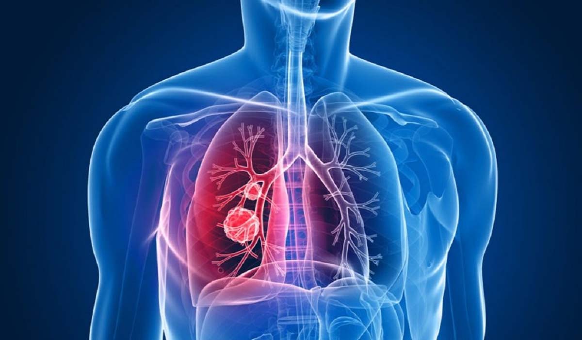 Zaturre Nedir 1675570665